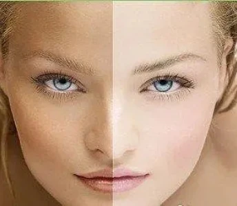 Èske glutathione blanchiman pèmanan?